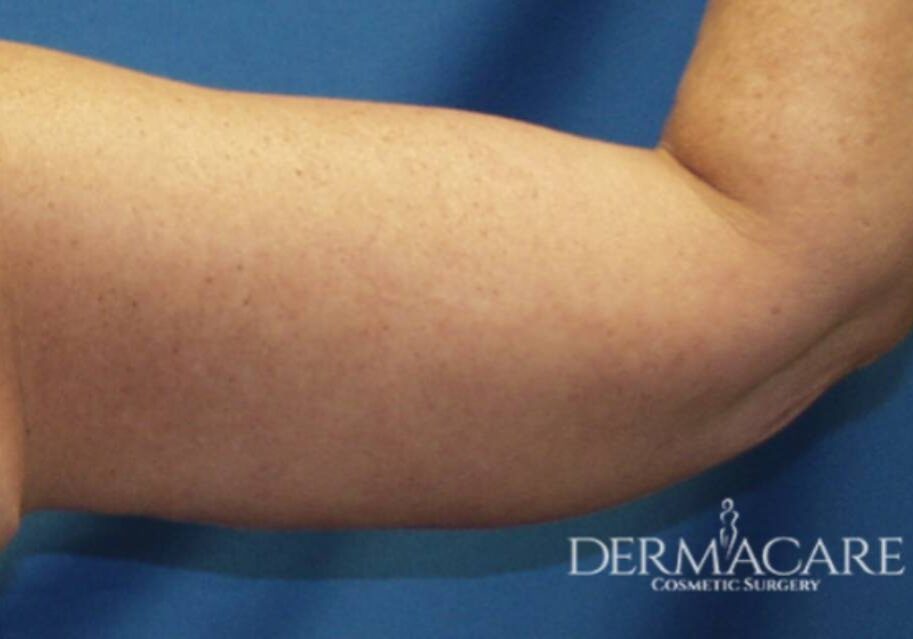 A woman 's arm with no visible vein on it.