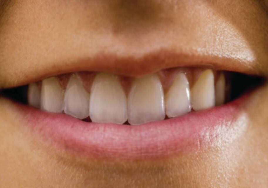 A close up of the teeth of a person with white teeth