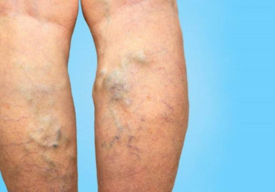 A person with varicose veins on their legs.